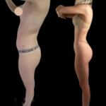 J-Plasma Treatment in Dubai