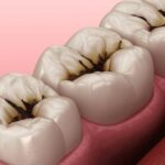 Stages Of Tooth Decay