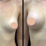 Breast Enlargement in dubai