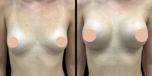 Breast Enlargement in dubai