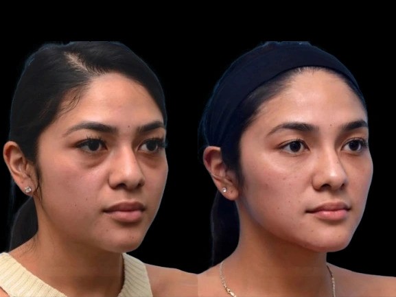 Dark Circles Treatment in Dubai