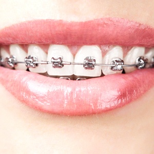 Braces near Naugatuck