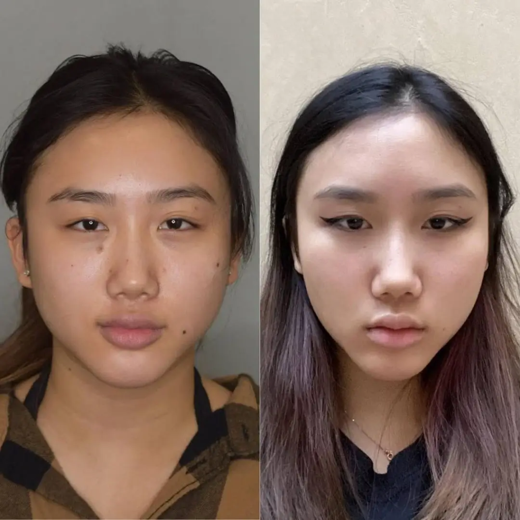 Buccal Fat Removal in Dubai