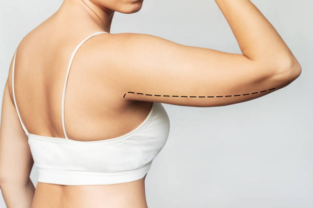 Can Liposuction Treat Fat Around the Arms