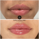 Juvederm in Dubai