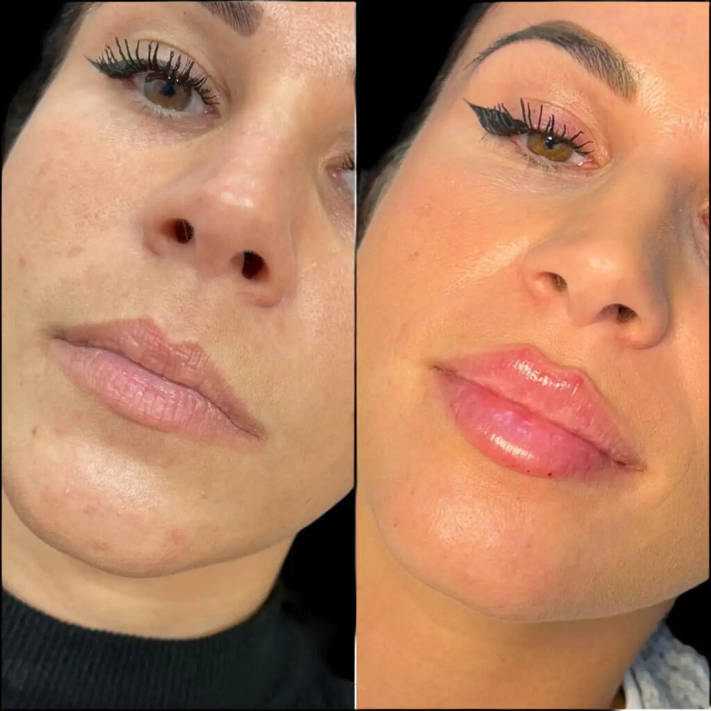 dermal fillers