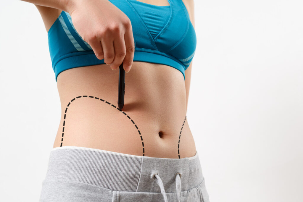 liposuction in dubai