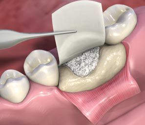 Bone Graft Dental Treatment