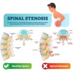 Spinal Stenosis