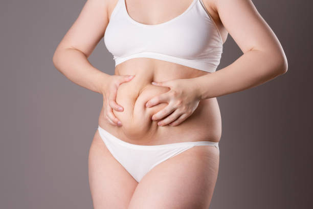 Why Is CoolSculpting Fat Freezing So Popular Now