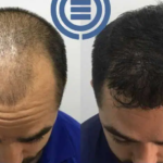 before and after hair transplantion