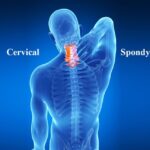 cervical spine issues
