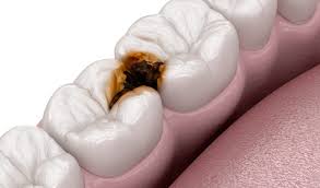 Black stuff on teeth