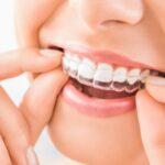 Invisalign Braces Dubai