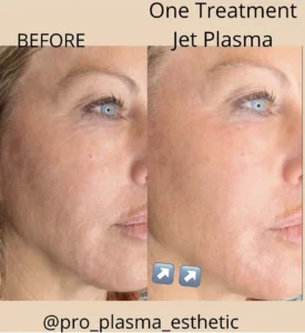 plasma treatment in novi