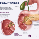 Ampullary Cancer