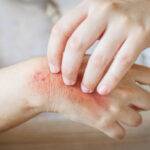 Can Eczema Treatment Heal Chronic Dry Skin