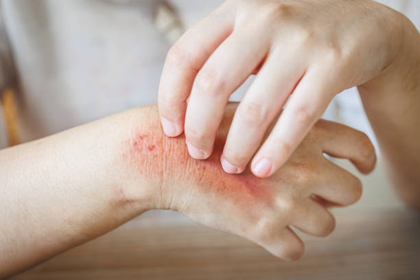 Can Eczema Treatment Heal Chronic Dry Skin