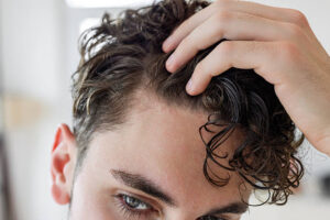 Can Hair Transplant Fix Severe Hair Loss