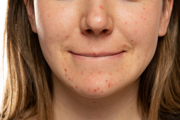 Can Laser Acne Scar Treatment Fade Dark Spots
