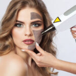Can Laser Carbon Peel treat active acne safely