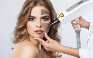 Can Laser Carbon Peel treat active acne safely