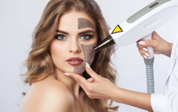 Can Laser Carbon Peel treat active acne safely