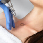 Can Laser Tattoo Removal Remove Large Tattoos
