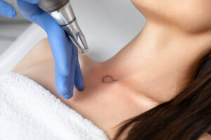 Can Laser Tattoo Removal Remove Large Tattoos