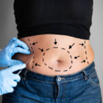 Can Tummy Tuck Be Combined With Liposuction