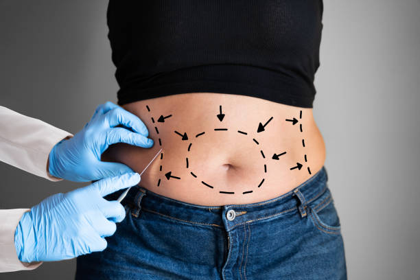 Can Tummy Tuck Be Combined With Liposuction