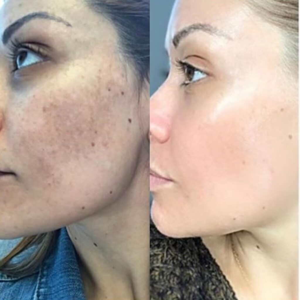 Cosmelan Pigmentation Treatment in Altrincham