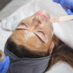 تكلفة جلسات التقشير الكيميائي