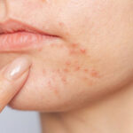 Does Acne Treatment treat oily skin effectively