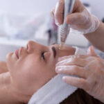 Does Dermapen Microneedling help stretch marks