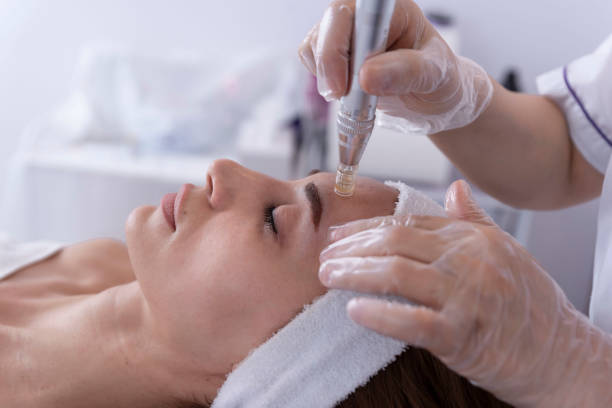 Does Dermapen Microneedling help stretch marks