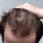 Does Hair Loss Treatment work for alopecia