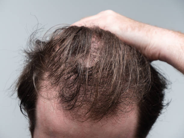 Does Hair Loss Treatment work for alopecia