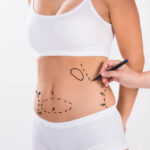 Does Liposuction Tighten Loose Skin Too
