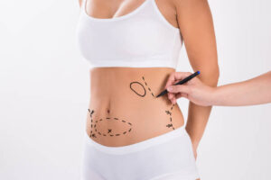 Does Liposuction Tighten Loose Skin Too