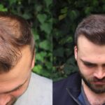 زراعة الشعر في دبي