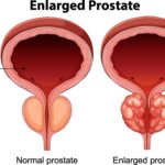 minimally invasive prostate treatment