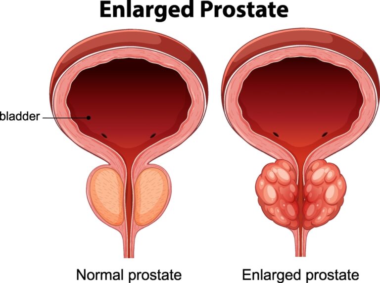minimally invasive prostate treatment