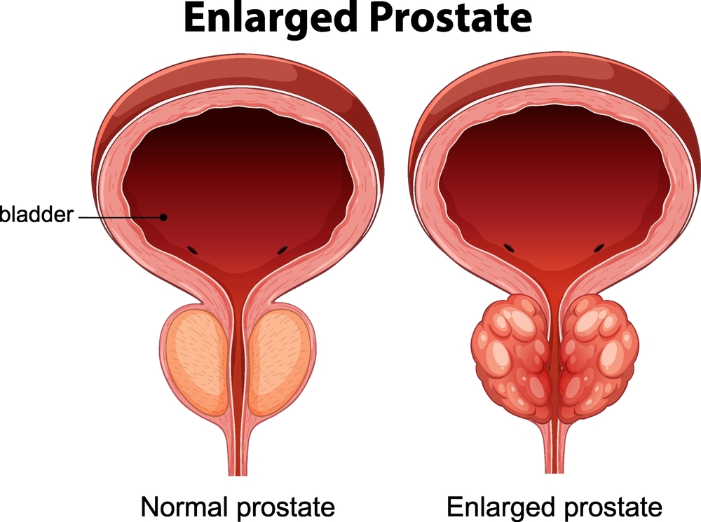 minimally invasive prostate treatment