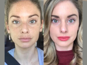 Radiofrequency (RF) Microneedling in Dubai