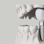 Surgical Guides -hero-SWdHXyjI