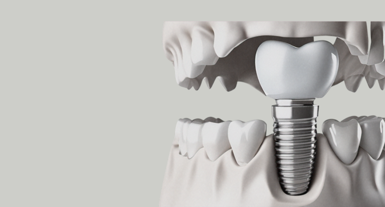 Surgical Guides -hero-SWdHXyjI