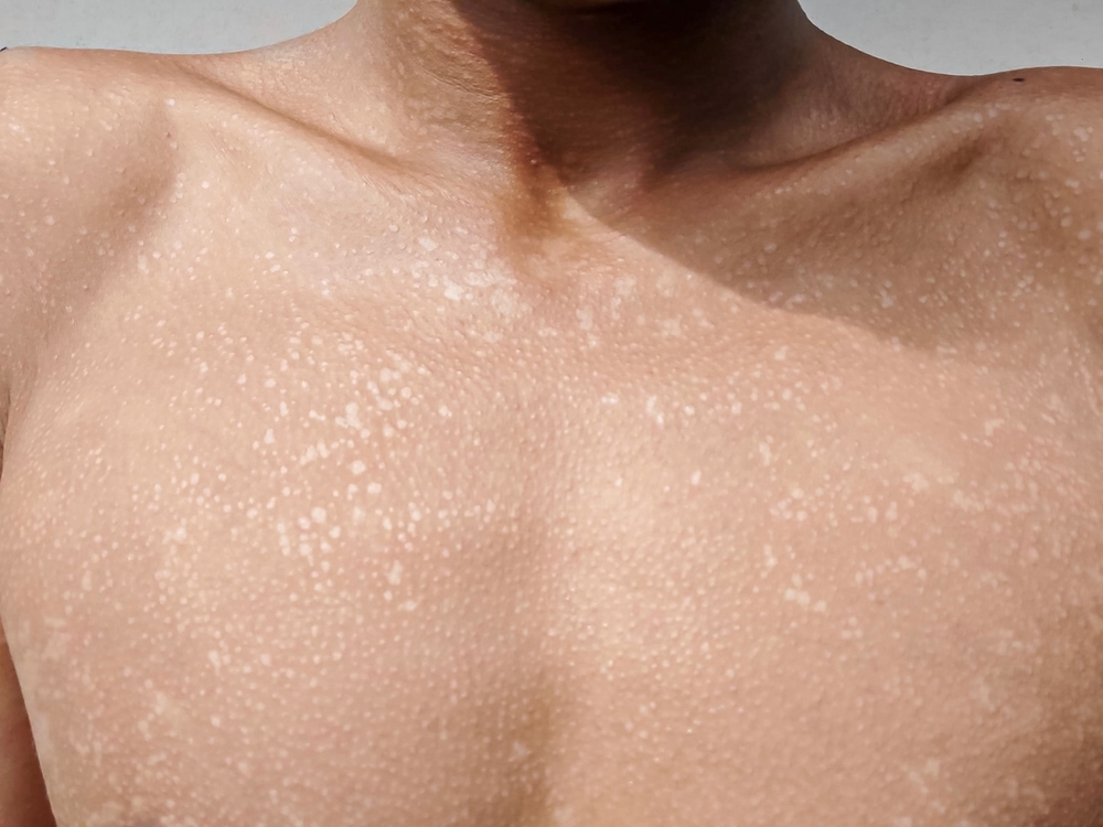 Tinea Versicolor