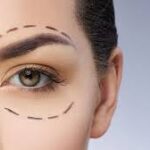 Upper blephroplasty in jeddah