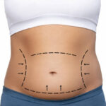 What Makes Liposuction a Popular Body Solution